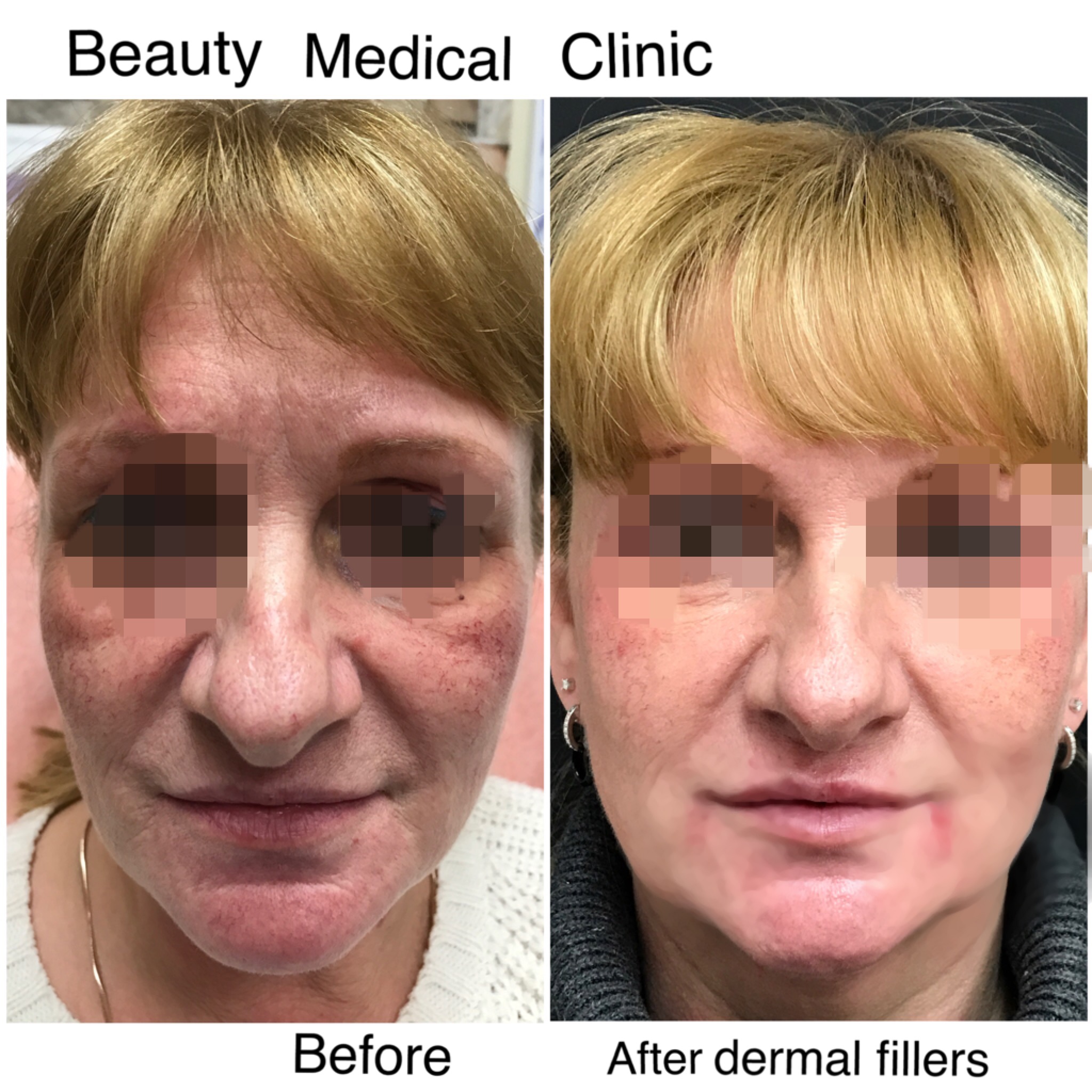 Dermal Fillers Before and After 4
