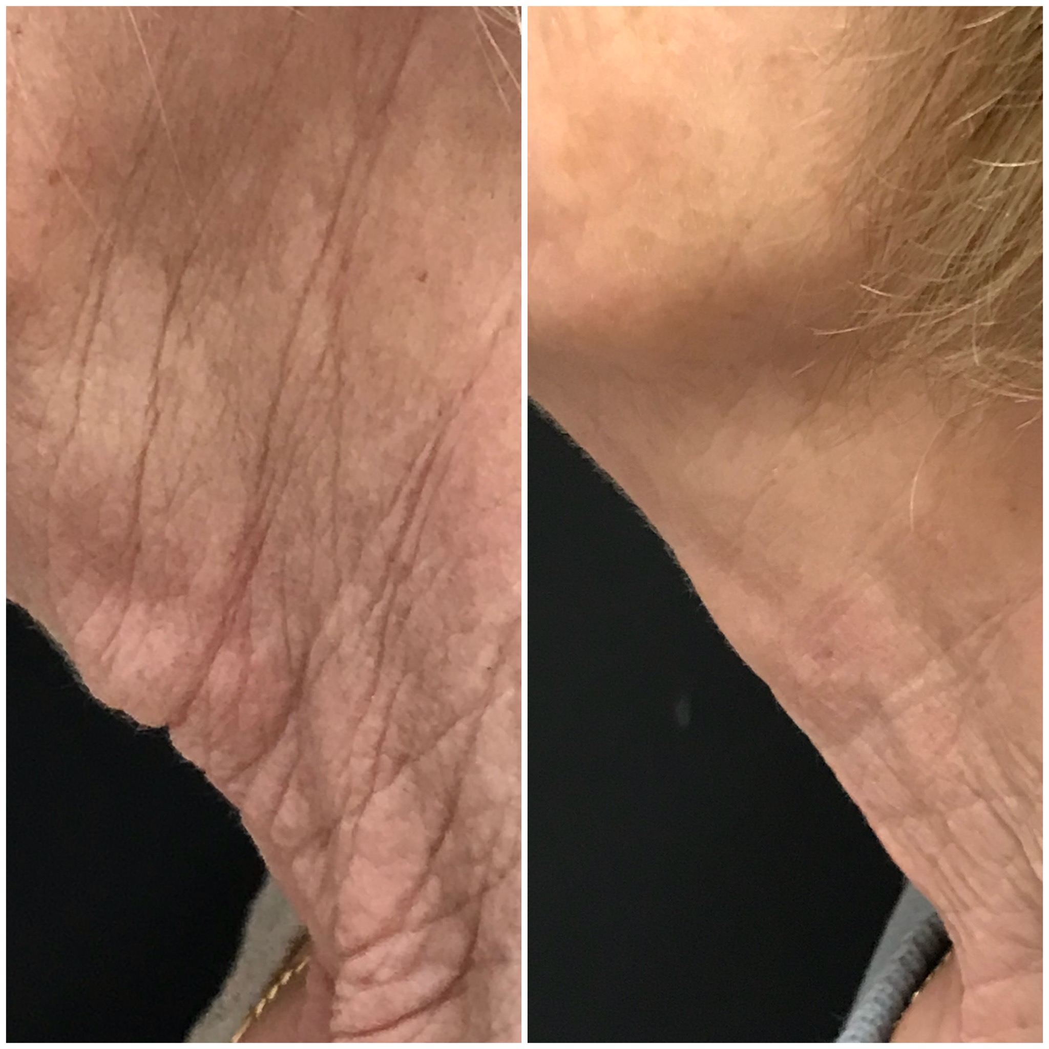 Face rejuvenation by Dermal fillers