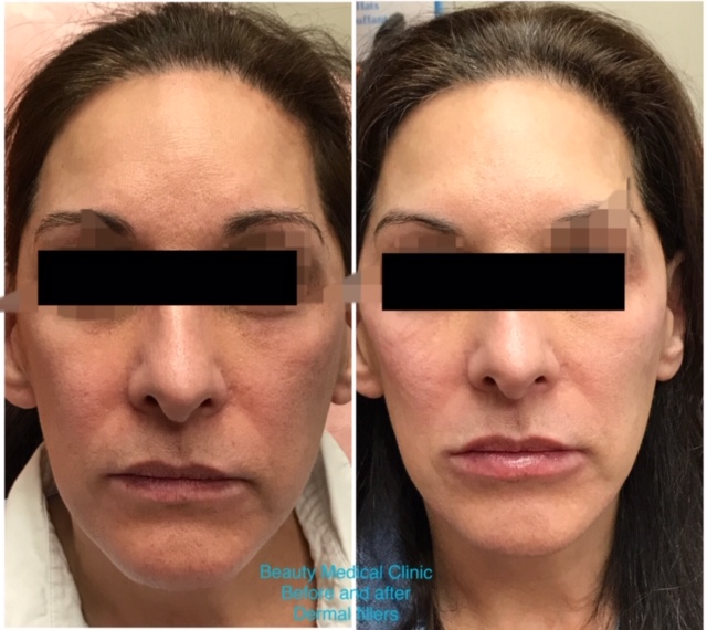 Dermal Fillers Before and After