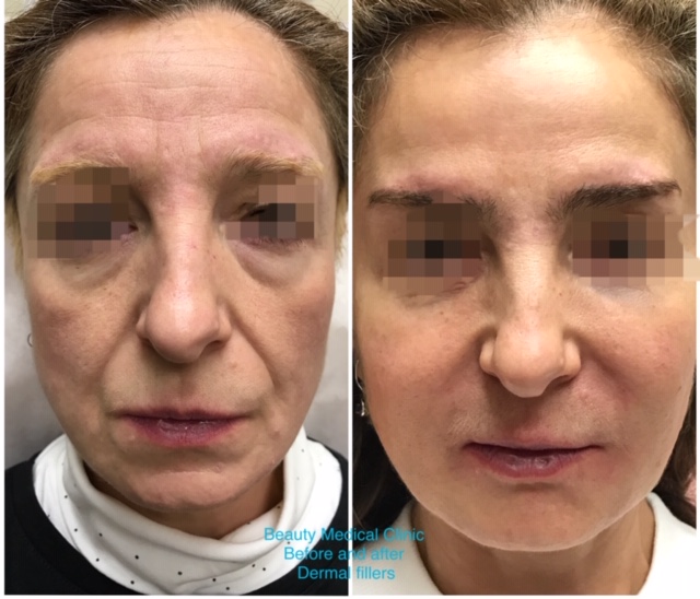 Dermal Fillers Before and After 2
