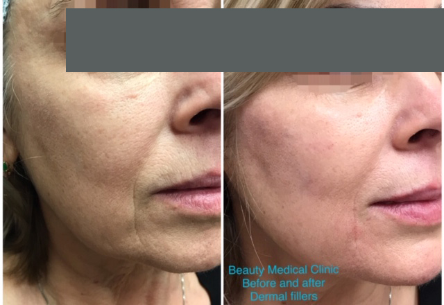 Dermal Fillers Before and After