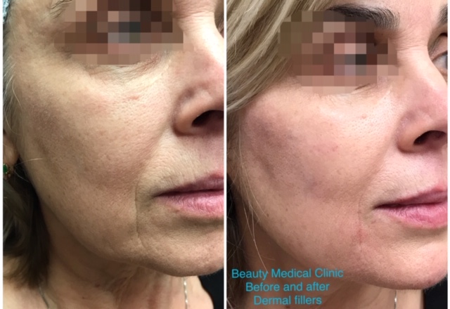 Derma Filles Before And After