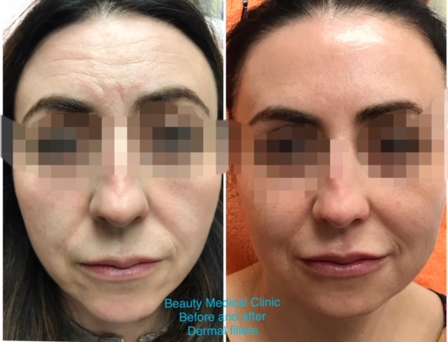 Derma Filles Before And After