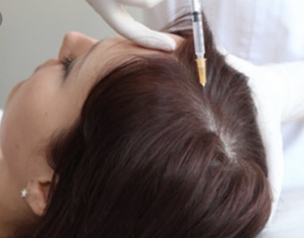 PRP HAIR LOSS TREATMENT