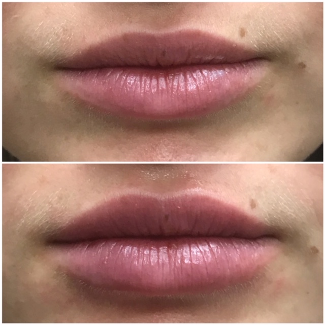 Lips before and after