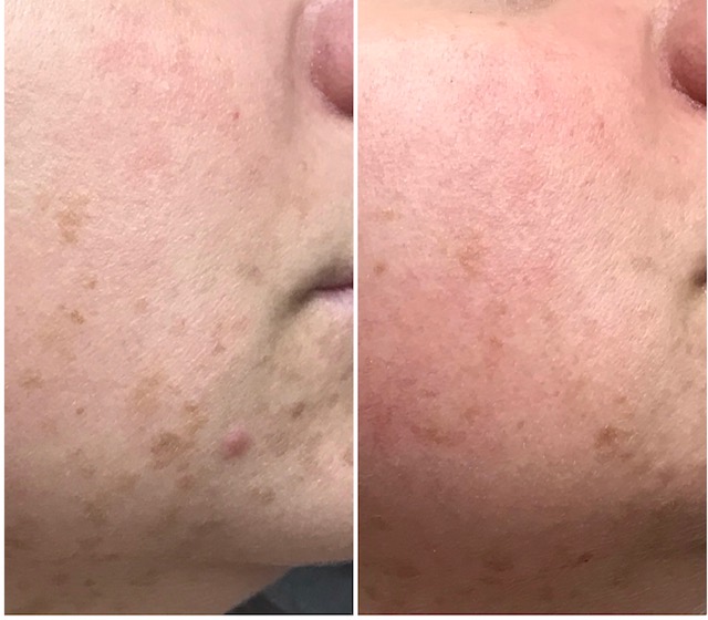 microneedling