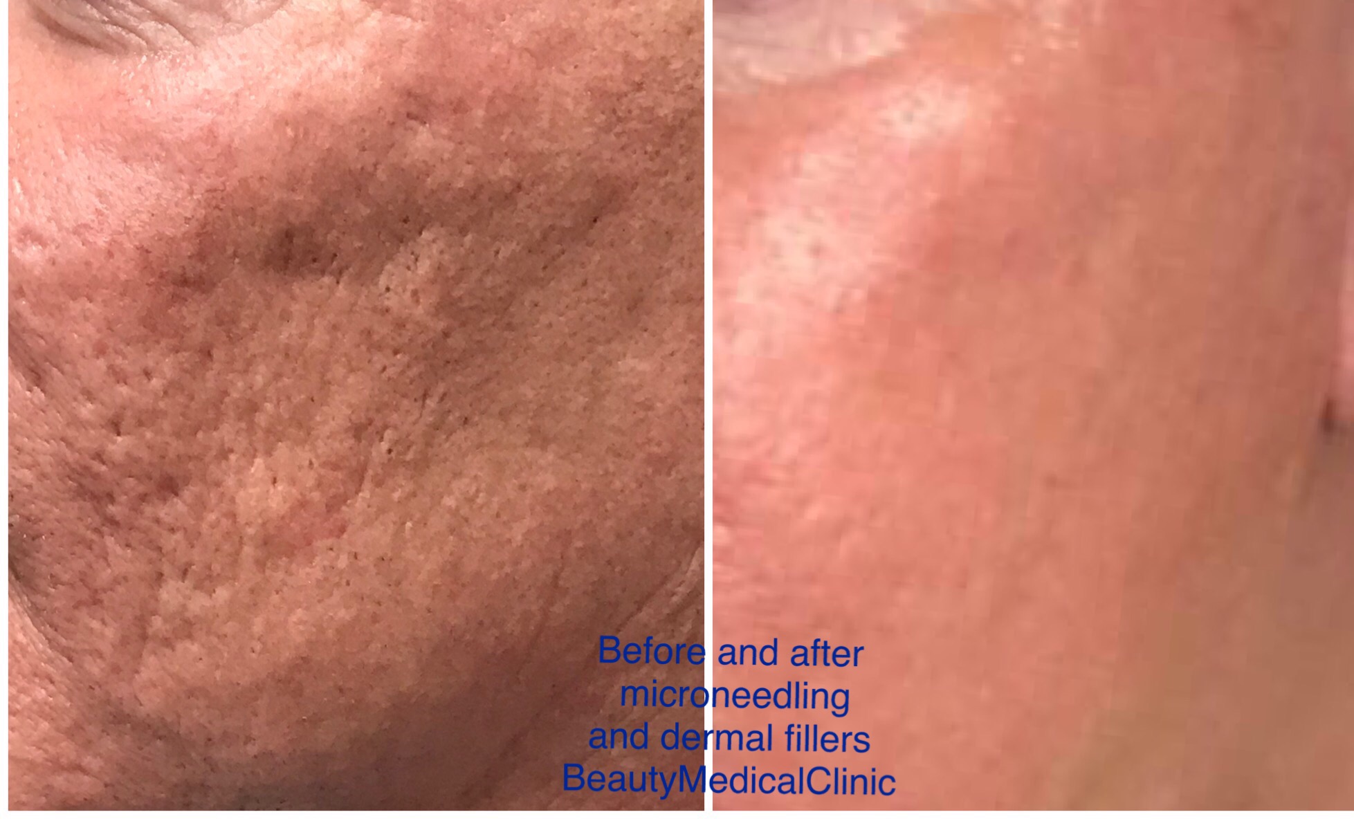 microneedling