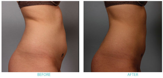 before after bodyfx