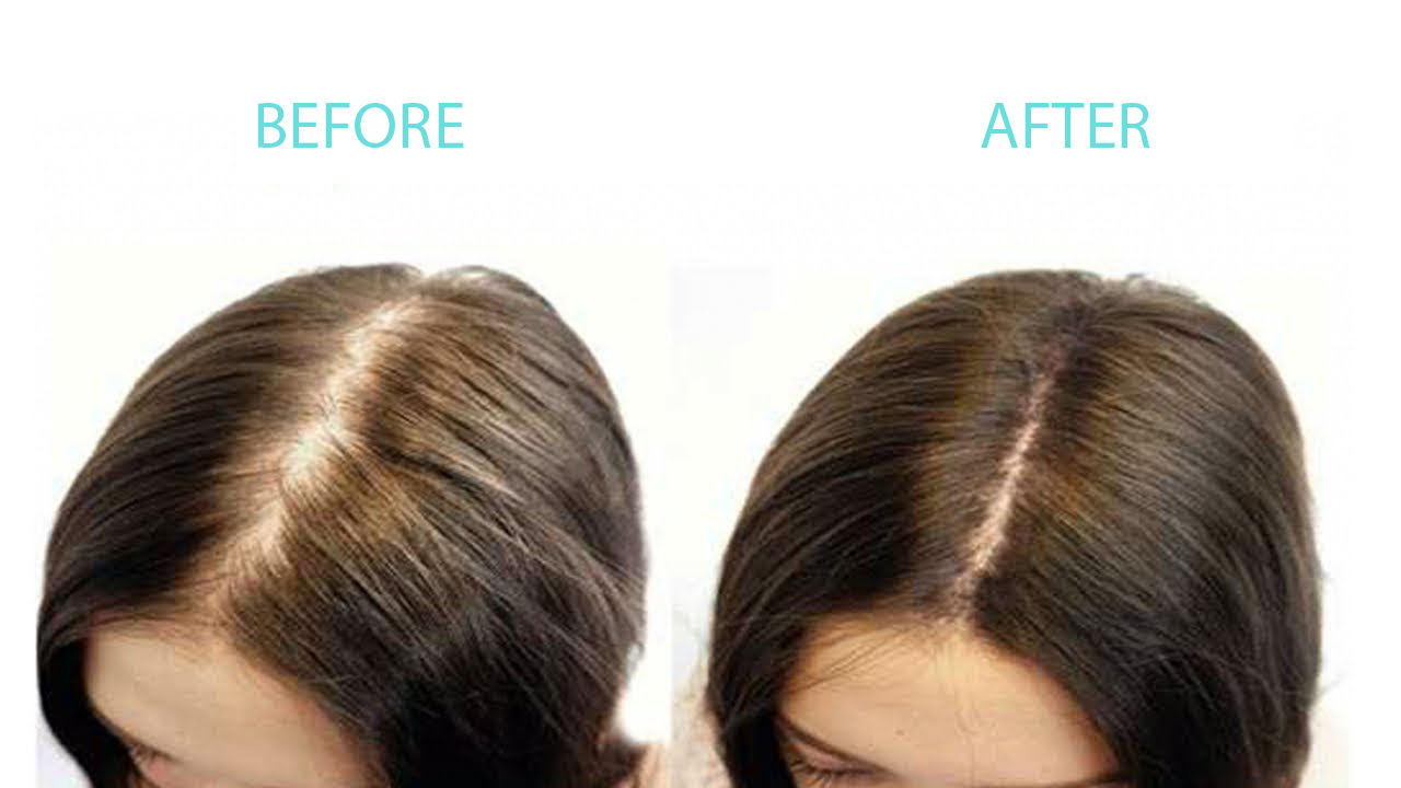 Hair thinning and loss treatment